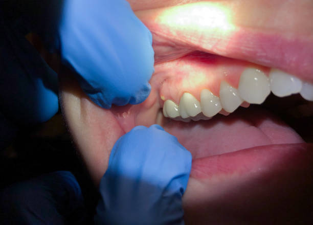 Best Tooth Infection Emergency Dentist  in Hoopeston, IL